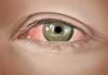 Photo for Allergic Conjunctivitis Market analysis and drive growth by 2023