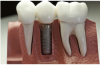 Photo for Affordable Dental Implants in Westlake, Austin TX