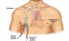 Photo for Catheters Market-Key Players: Johnson & Johnson Inc., Abbott Laboratories, Becton, Dickson and Company, B. Braun Melsungen AG