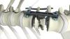 Photo for Thoracolumbar Spine Devices Market World Leading Key Players Revenue, Share, Analysis and Estimation Till 2023