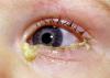 Photo for Fungal Eye Infections Market SWOT Analysis, Key Development Areas, Financial Overview and Forecasts Till 2023