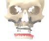 Photo for TMJ Implants Market Evolving Technology, Trends and Industry Analysis 2020