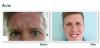 Photo for Obagi Tretinoin Cream For Acne Treatment