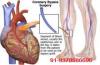 Photo for Coronary Artery Bypass Grafting Surgery in India