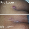 Photo for Laser Treatment for Piles in Dubai - Orchid Laser Center