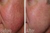 Photo for Facial Spider vein treatment Honolulu