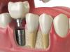 Photo for Global Dental Implants Market Trend, Share and Forecast till 2024