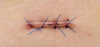 Photo for Dissolvable Sutures Market Shares Analysis, Key Development Strategies and Forecasts Till 2023