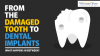 Photo for The Damaged Tooth To Dental Implants: Dental Implants Plainfield IL #Dental  #Dentist #Dentalimplant