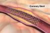 Photo for Coronary Stents Market Revenue Opportunies, Growth, Trends and Forecast to 2026