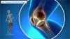 Photo for Joint Replacement Market Potential Growth, Analysis, Strategies and Forecast 2024