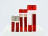 Photo for Hematocrit Test Market Top Key Players Shares, Revenue, Analysis and Forecasts to 2023