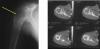 Photo for Ewing Sarcoma Therapeutics - Pipeline Analysis and Developments