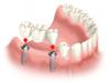 Photo for Dental  Implant