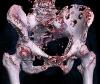 Photo for Bone metastasis Market SWOT Analysis, Key Development Areas, Financial Overview and Forecasts Till 2023