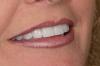 Photo for Porcelain Veneers