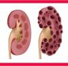 Photo for Kidney Infections Market In depth Industry Analysis, Key Development Areas, Financial Overview and Forecasts Till 2023