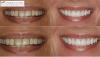 Photo for Teeth Whitening
