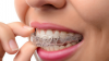 Photo for Invisalign & Braces for Beautiful Smile