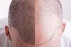 Photo for Global Hair Transplant Market Growth Driver, Regional Outlook, Developments and Forecast to 2025