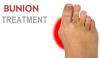 Photo for Bunion (hallux valgus) Treatment Market - Top Devices In the Market By Sales and Revenue, New Treatment and Regional Forecast till 2023