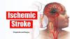 Photo for Ischemic Strokes Market CAGR Growth Expected To Be Linear To The Skyrocketing Rise In The Cases Of Trauma! Predicted By 2023