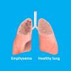 Photo for World Emphysema Market Top Key Players Shares, Revenue, Analysis and Forecasts to 2023