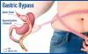 Photo for Gastric Bypass Market 2017 - Shares, Revenue, Analysis and Forecasts Till 2023