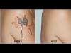 Photo for Looking For the Best Tattoo Removal Clinic