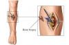 Photo for Bone Biopsy Market Analysis of Top Players, Share, Growth, Region Wise, Application and Forecasts by 2025