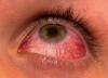 Photo for Diabetic Retinopathy Market Evolving Major Demand in Healthcare Industry Worldwide Till 2023