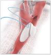 Photo for Vascular Patches Market Growth Analysis and Future Demand with Forecast up to 2024