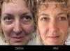 Photo for Vampire facial Toronto