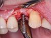 Photo for Why You need a Best Implant Dentist in Delhi
