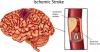 Photo for Ischemic strokes Market 2017 - Shares, Revenue, Analysis and Forecasts Till 2023