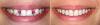 Photo for Who Can Get Dental Implants? Ask a Dentist in Clifton!