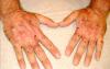 Photo for Global Acute Intermittent Porphyria Market Global Industry Analysis, Growth and Forecast, 2018-2025 - Data Bridge Market Research