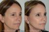 Photo for 5 Questions to Ask Yourself Before Getting Cosmetic Surgery