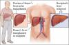 Photo for Best Hospitals for Liver Transplant in India: best and affordable treatment