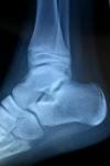 Photo for Global Foot And Ankle Allograft Market is Growing at a Significant Rate in the Forecast Period 2018-2025