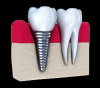 Photo for Best Dental Implant Clinics and Hospitals in India
