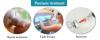 Photo for Global Psoriasis Treatment Market poised to reach US$ 20,388.2 Mn by 2023 with a significant CAGR over the forecast period (2018-2023)