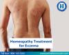 Photo for Get Eczema Treated With Homeopathy