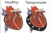 Photo for Global Cardiac Tamponade Market 2018-2025 - Industry Trends, Market Size, Segments, Growth Prospects