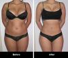 Photo for Fat Freeze Treatment