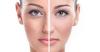 Photo for Dark Circles Removal in Dubai