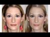 Photo for Follow All Precautions Mentioned by your Rhinoplasty Toronto Doctor to Get Comfort after Surgery