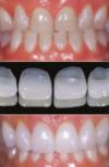 Photo for Enjoy the pleasure of a fascinating smile without extracting your teeth