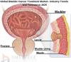 Photo for Global Bladder Cancer Treatment Market 2018-2025 – Market Estimate, Competitive Landscape, Industry Size