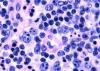 Photo for Peripheral T-Cell Lymphoma Treatment Market Dynamics, Forecast, Analysis and Supply Demand